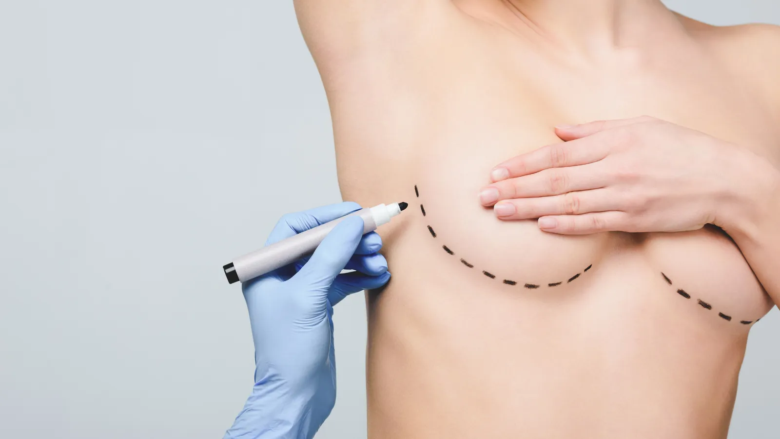 Recovery Timeline After a Breast Reduction: What to Expect at Each Stage