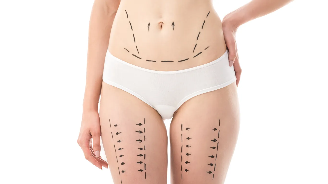 Liposucción antes y después: expectativas realistas del contorno corporal
