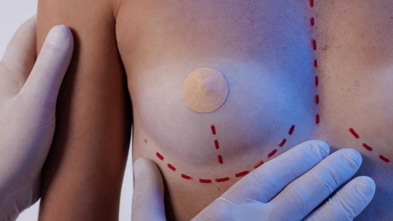 Breast Reduction Before and After: Functional and Aesthetic Improvements